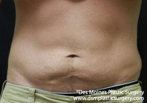 CoolSculpting Before and After Photo by Coachlight Clinic & Spa in West Des Moines Iowa