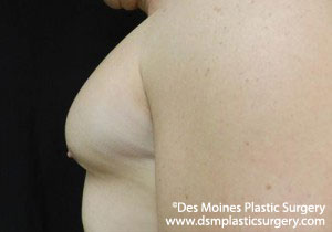 CoolSculpting Before and After Photo by Coachlight Clinic & Spa in West Des Moines Iowa