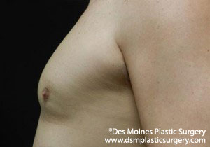 CoolSculpting Before and After Photo by Coachlight Clinic & Spa in West Des Moines Iowa