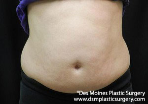 CoolSculpting Before and After Photo by Coachlight Clinic & Spa in West Des Moines Iowa