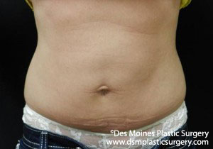 CoolSculpting Before and After Photo by Coachlight Clinic & Spa in West Des Moines Iowa