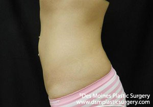 CoolSculpting Before and After Photo by Coachlight Clinic & Spa in West Des Moines Iowa
