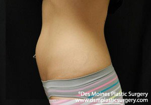 CoolSculpting Before and After Photo by Coachlight Clinic & Spa in West Des Moines Iowa