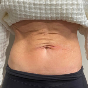 HALO Before and After Photo by Coachlight Clinic & Spa in West Des Moines Iowa