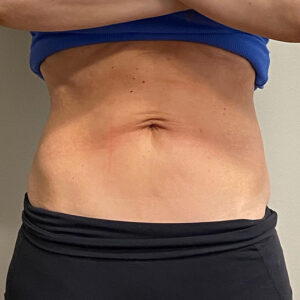 HALO Before and After Photo by Coachlight Clinic & Spa in West Des Moines Iowa