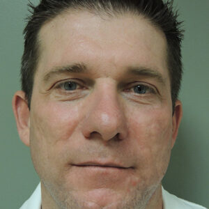 Laser Resurfacing Before and After Photo by Coachlight Clinic & Spa in West Des Moines Iowa