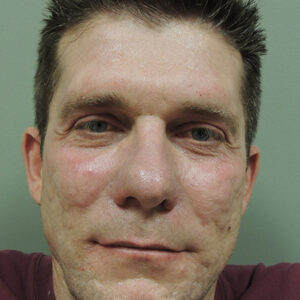 Laser Resurfacing Before and After Photo by Coachlight Clinic & Spa in West Des Moines Iowa