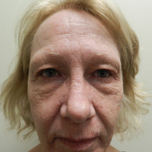 Laser Resurfacing Before and After Photo by Coachlight Clinic & Spa in West Des Moines Iowa