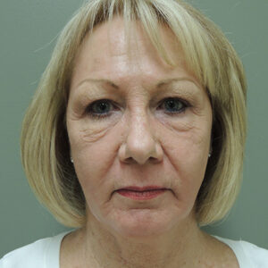 Laser Resurfacing Before and After Photo by Coachlight Clinic & Spa in West Des Moines Iowa