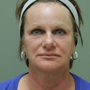 Laser Resurfacing Before and After Photo by Coachlight Clinic & Spa in West Des Moines Iowa