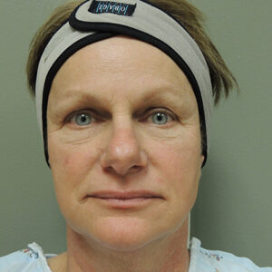 Laser Resurfacing Before and After Photo by Coachlight Clinic & Spa in West Des Moines Iowa