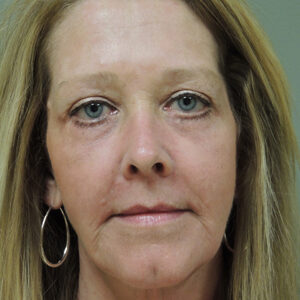 Laser Resurfacing Before and After Photo by Coachlight Clinic & Spa in West Des Moines Iowa