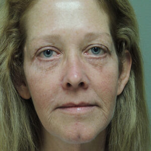 Laser Resurfacing Before and After Photo by Coachlight Clinic & Spa in West Des Moines Iowa
