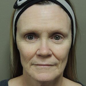 Laser Resurfacing Before and After Photo by Coachlight Clinic & Spa in West Des Moines Iowa