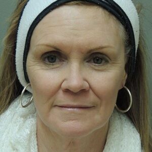 Laser Resurfacing Before and After Photo by Coachlight Clinic & Spa in West Des Moines Iowa