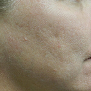 BBL® & BBL® HERO™ Before and After Photo by Coachlight Clinic & Spa in West Des Moines Iowa