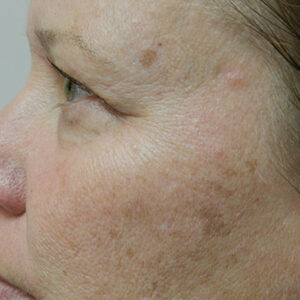 BBL® & BBL® HERO™ Before and After Photo by Coachlight Clinic & Spa in West Des Moines Iowa