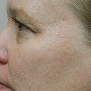 BBL® & BBL® HERO™ Before and After Photo by Coachlight Clinic & Spa in West Des Moines Iowa