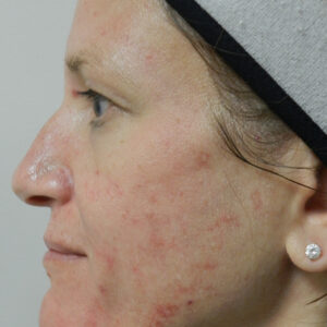 BBL® & BBL® HERO™ Before and After Photo by Coachlight Clinic & Spa in West Des Moines Iowa