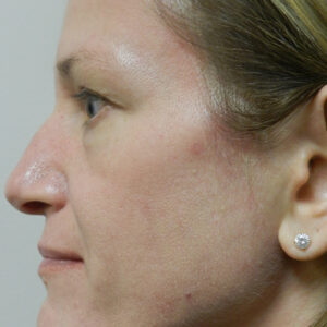 BBL® & BBL® HERO™ Before and After Photo by Coachlight Clinic & Spa in West Des Moines Iowa