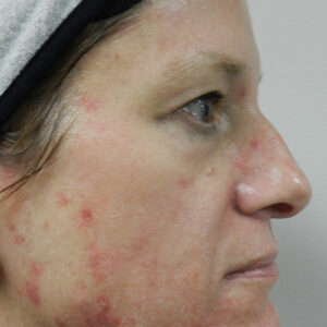 BBL® & BBL® HERO™ Before and After Photo by Coachlight Clinic & Spa in West Des Moines Iowa
