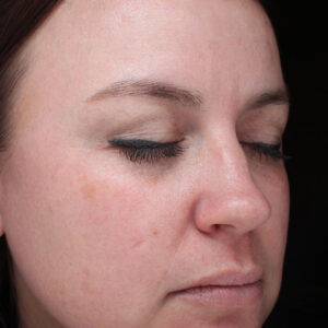 Halo treatment Before and After Photo by Coachlight Clinic Spa in West Des Moines Iowa