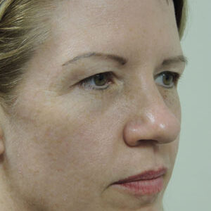 BBL® & BBL® HERO™ Before and After Photo by Coachlight Clinic & Spa in West Des Moines Iowa