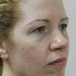 BBL® & BBL® HERO™ Before and After Photo by Coachlight Clinic & Spa in West Des Moines Iowa