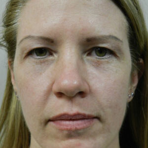 BBL® & BBL® HERO™ Before and After Photo by Coachlight Clinic & Spa in West Des Moines Iowa