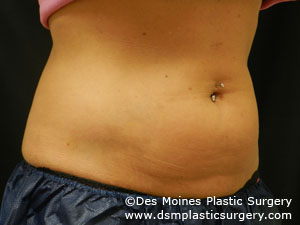CoolSculpting Before and After Photo by Coachlight Clinic & Spa in West Des Moines Iowa