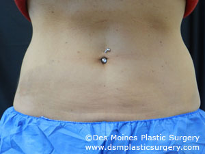 CoolSculpting Before and After Photo by Coachlight Clinic & Spa in West Des Moines Iowa