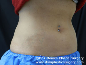 CoolSculpting Before and After Photo by Coachlight Clinic & Spa in West Des Moines Iowa
