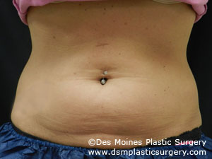 CoolSculpting Before and After Photo by Coachlight Clinic & Spa in West Des Moines Iowa