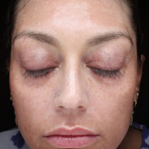MOXI Before and After Photo by Coachlight Clinic & Spa in West Des Moines Iowa