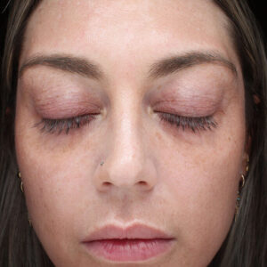 MOXI Before and After Photo by Coachlight Clinic & Spa in West Des Moines Iowa