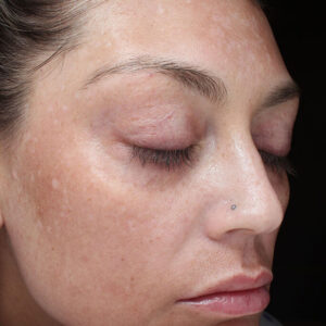 MOXI Before and After Photo by Coachlight Clinic & Spa in West Des Moines Iowa