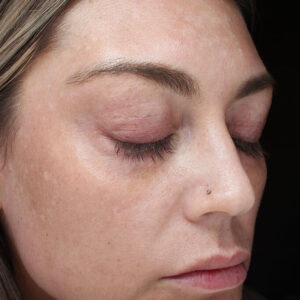 MOXI Before and After Photo by Coachlight Clinic & Spa in West Des Moines Iowa