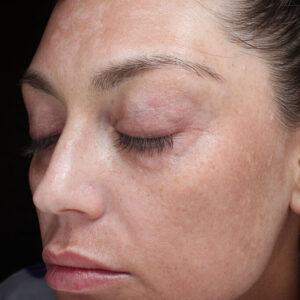 MOXI Before and After Photo by Coachlight Clinic & Spa in West Des Moines Iowa