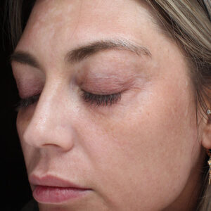 MOXI Before and After Photo by Coachlight Clinic & Spa in West Des Moines Iowa