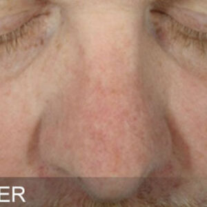HydraFacial Before and After Photo by Coachlight Clinic & Spa in West Des Moines Iowa