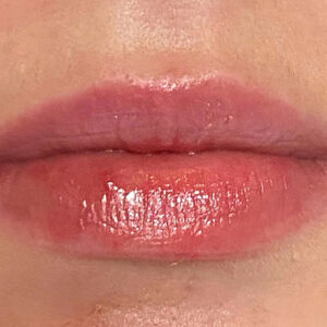 Lip Filler Before and After Photo by Coachlight Clinic & Spa in West Des Moines Iowa