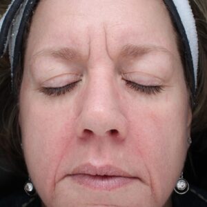 HALO Before and After Photo by Coachlight Clinic & Spa in West Des Moines Iowa