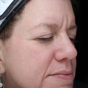 HALO Before and After Photo by Coachlight Clinic & Spa in West Des Moines Iowa
