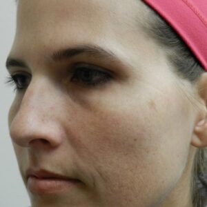 HALO Before and After Photo by Coachlight Clinic & Spa in West Des Moines Iowa