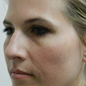 HALO Before and After Photo by Coachlight Clinic & Spa in West Des Moines Iowa