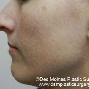 HALO Before and After Photo by Coachlight Clinic & Spa in West Des Moines Iowa