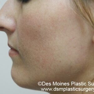 HALO Before and After Photo by Coachlight Clinic & Spa in West Des Moines Iowa