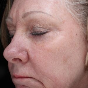 HALO Before and After Photo by Coachlight Clinic & Spa in West Des Moines Iowa