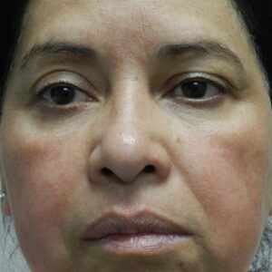 HALO Before and After Photo by Coachlight Clinic & Spa in West Des Moines Iowa