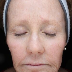 HALO Before and After Photo by Coachlight Clinic & Spa in West Des Moines Iowa